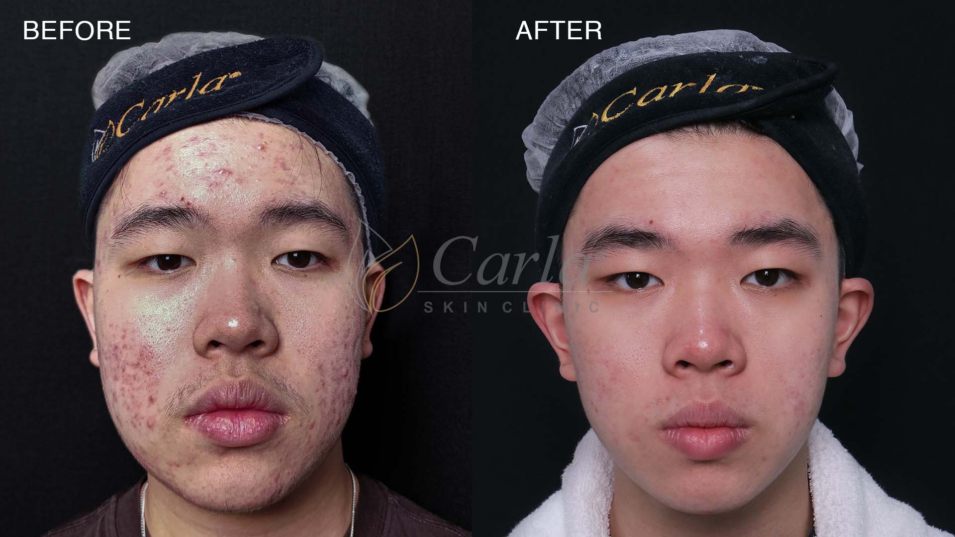 Before after perawatan acne di Carla Skin Clinic
