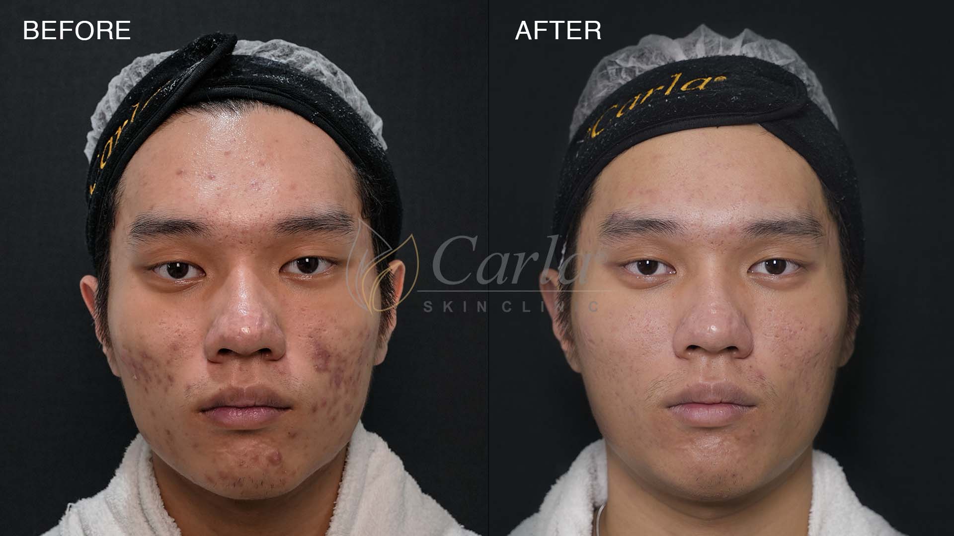 Before after perawatan acne di Carla Skin Clinic