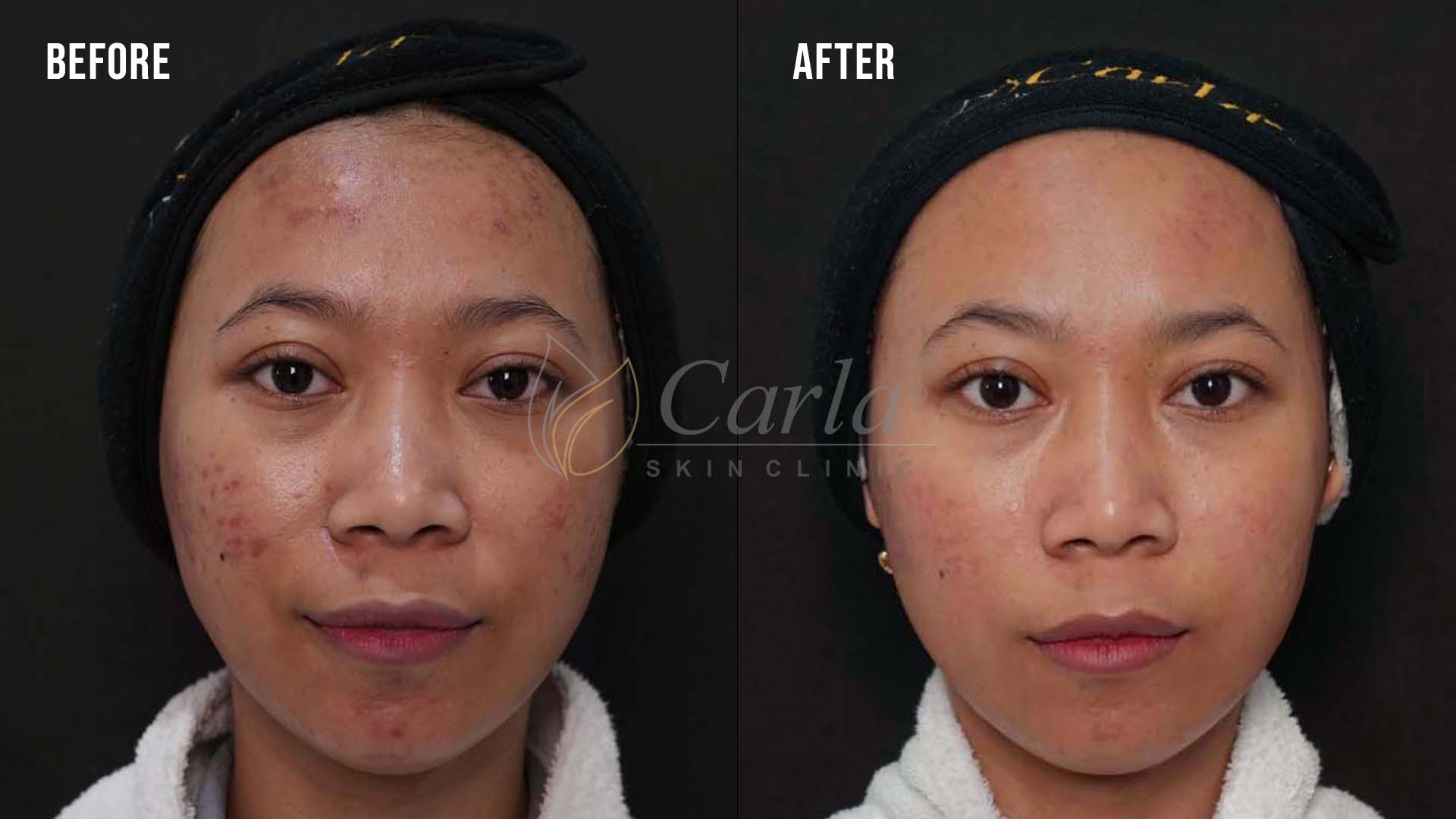 Before after perawatan acne di Carla Skin Clinic