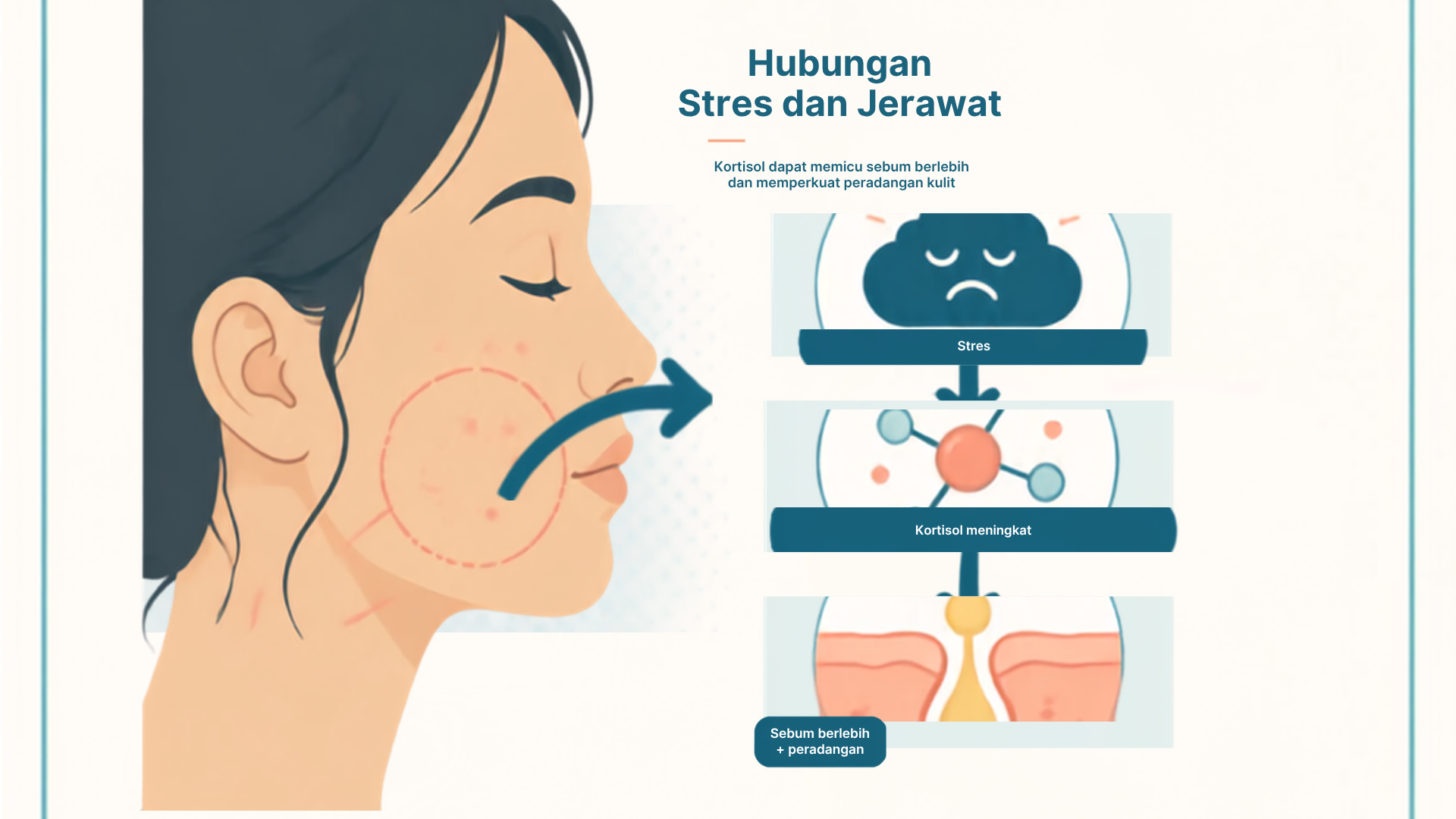 Jerawat karena Stres, Benarkah Bisa Terjadi?