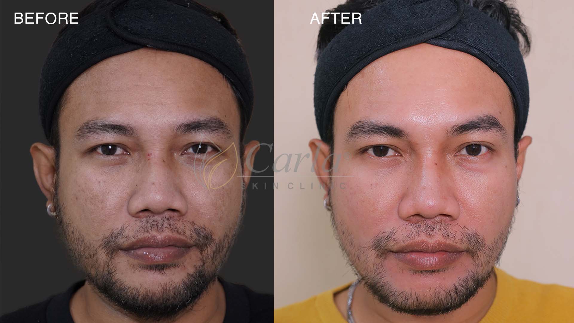 Before after perawatan hiperpigmentasi di Carla Skin Clinic