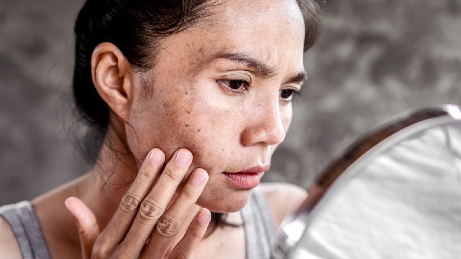 Hiperpigmentasi vs Melasma: Apa Bedanya dan Mengapa Berbeda Pula Cara Merawatnya?