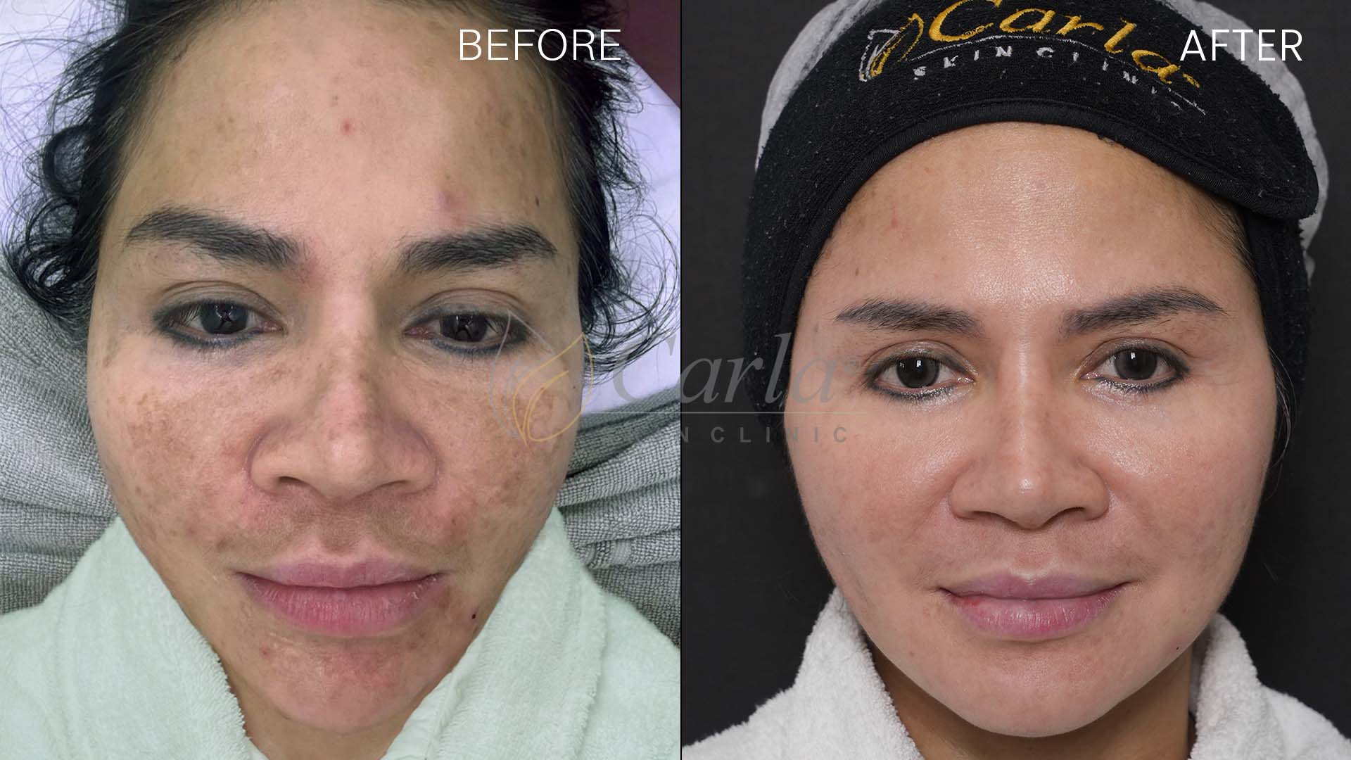 Before after perawatan hiperpigmentasi di Carla Skin Clinic