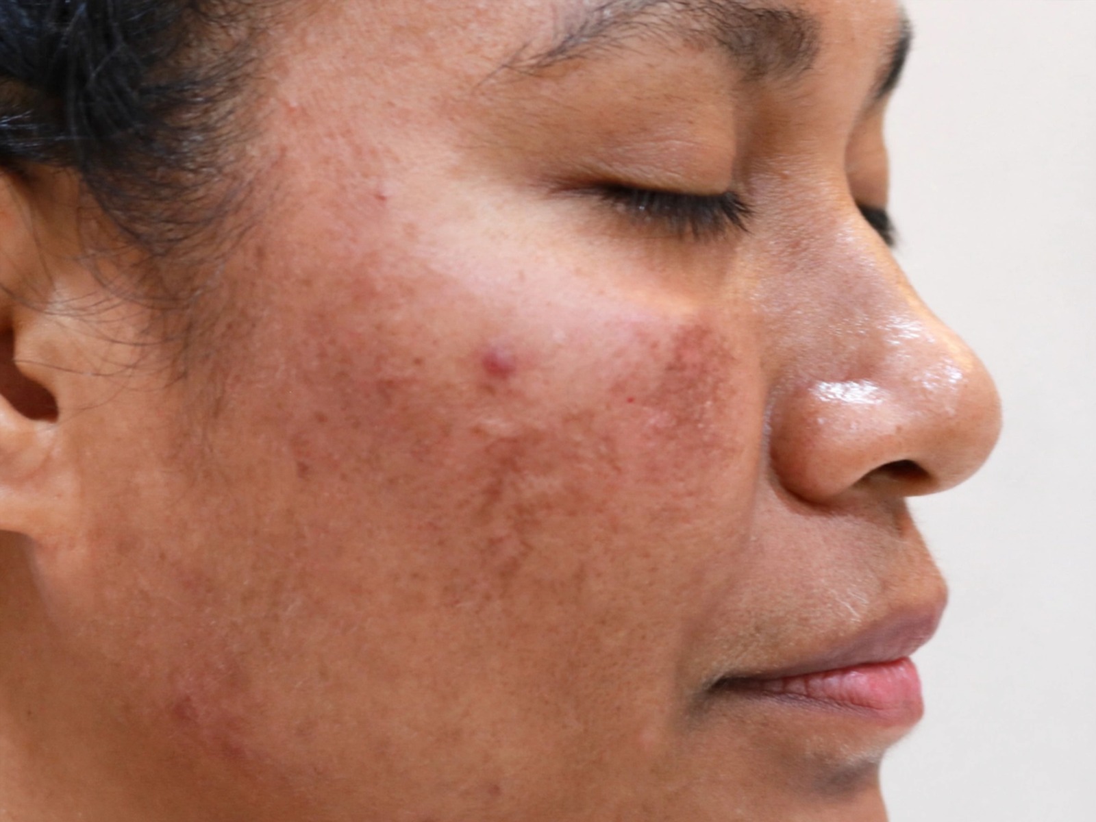 Gaya Hidup dan Pola Makan untuk Membantu Menjaga Kulit dari Melasma
