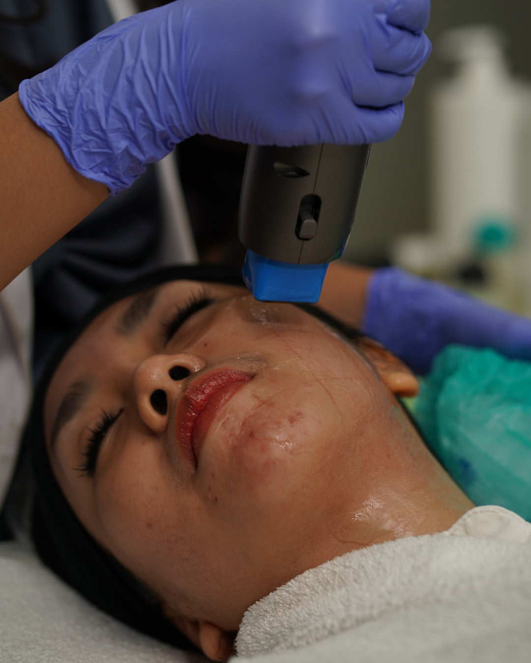 Proses 10Sculpt Advance Lift menggunakan 10Therma Monopolar RF sebagai perawatan skin tightening untuk membantu meningkatkan kekencangan dan firmness kulit.