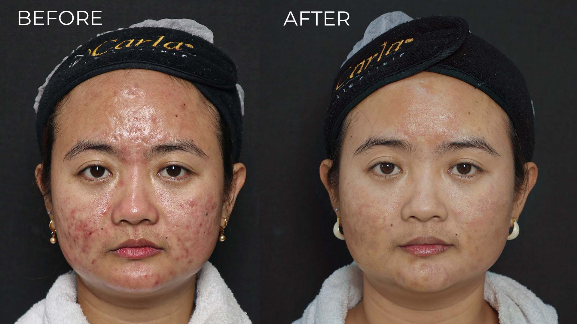 Before After Trifill Scar Revival untuk Bopeng Bekas Jerawat Before after Trifill Scar Revival yang menunjukkan perubahan tampilan bopeng bekas jerawat dan tekstur kulit setelah perawatan di Carla Skin Clinic.
