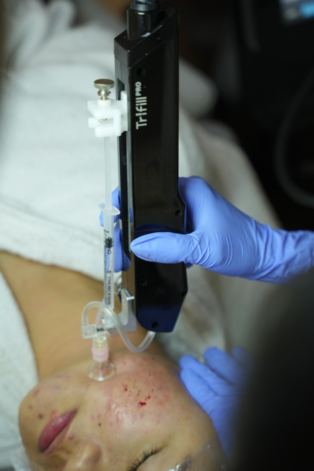 Trifill Scar Revival dari Carla Skin Clinic adalah perawatan bekas jerawat cekung (bopeng) berbasis teknologi Trifill Pro dari Korea Selatan yang membantu memperbaiki jaringan parut dari lapisan kulit lebih dalam melalui kombinasi micro-subcision CO₂ dan serum regeneratif. Treatment ini bertujuan membantu meratakan tekstur kulit, menyamarkan bopeng, serta merangsang pembentukan kolagen untuk kulit yang lebih halus, sehat, dan tampak lebih percaya diri.