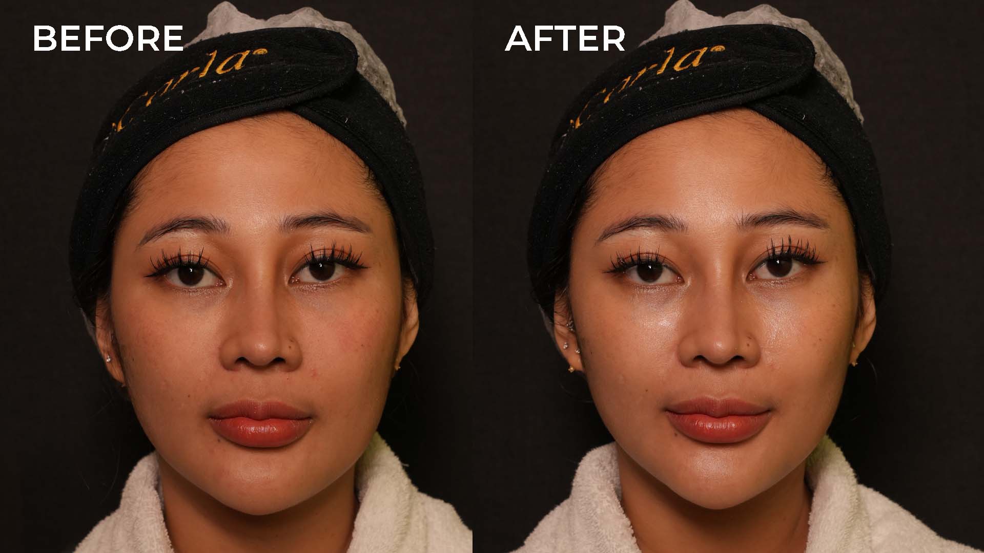 Before After Trinity Instant Lift
