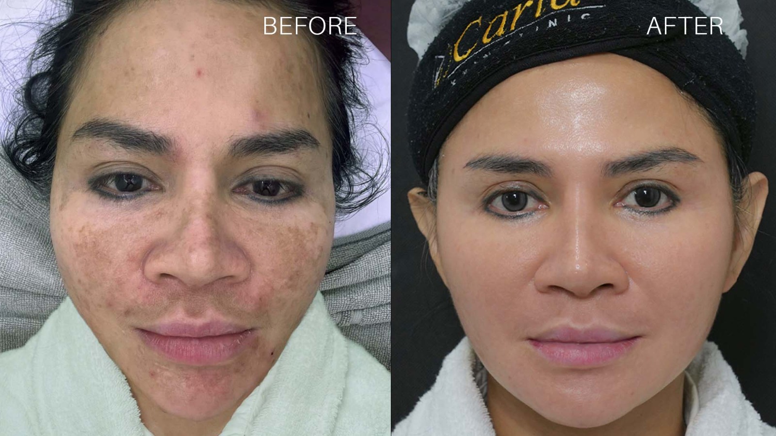 Before After Perawatan Cosmelan Carla Skin Clinic Before after perawatan Cosmelan di Carla Skin Clinic yang menunjukkan perubahan tampilan pigmentasi dan warna kulit menjadi lebih merata.
