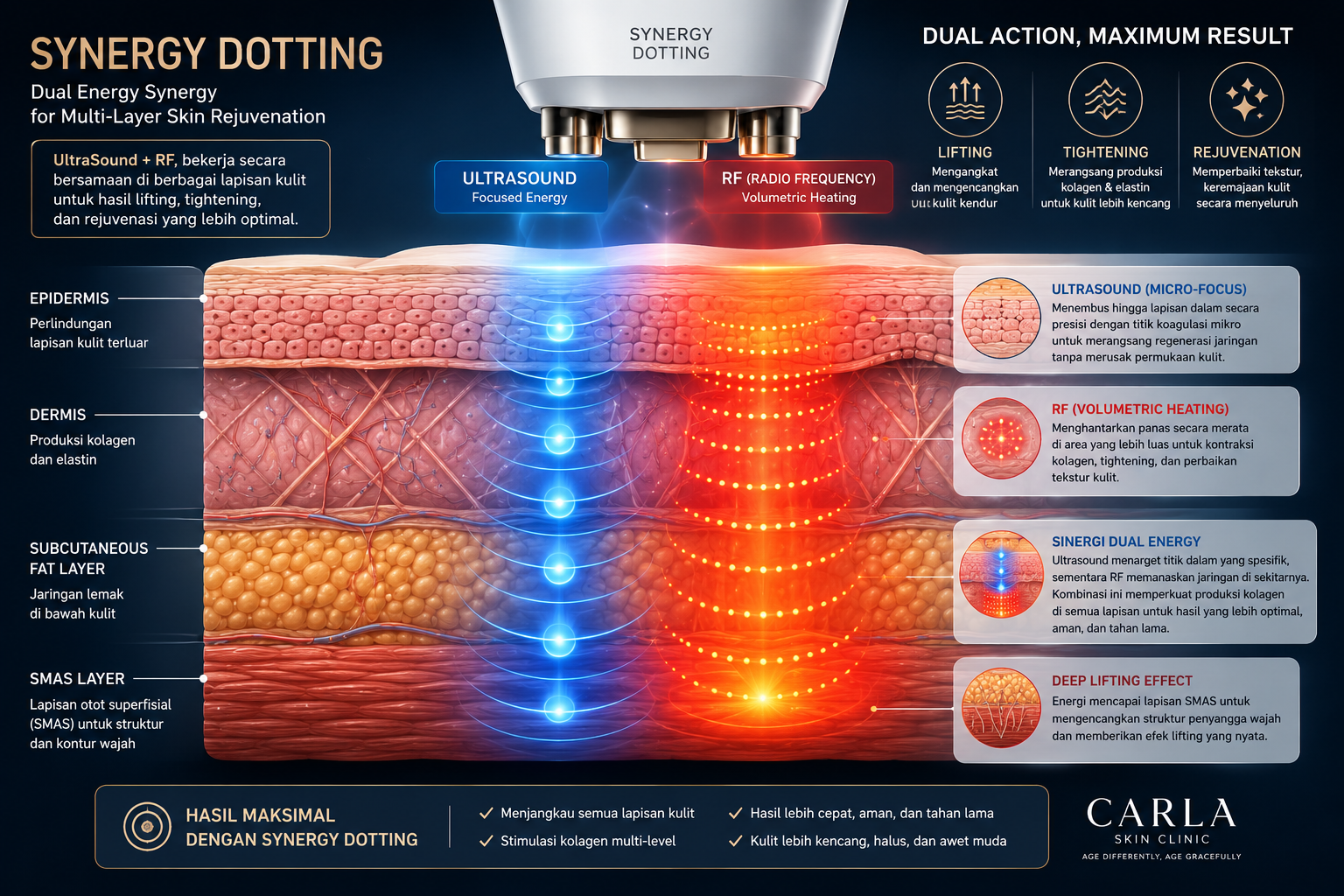 Ilustrasi teknologi Synergy Dotting yang menunjukkan bagaimana energi ultrasound dan RF bekerja di berbagai lapisan kulit secara bersamaan
