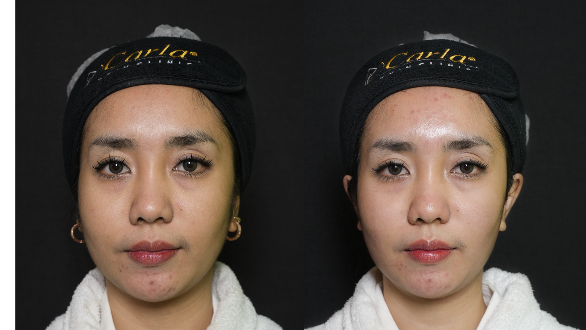 Lihat hasil before-after 10 Therma Face Lift di Carla Skin Clinic, treatment berbasis monopolar RF untuk membantu mengencangkan kulit dan mempertegas kontur wajah.