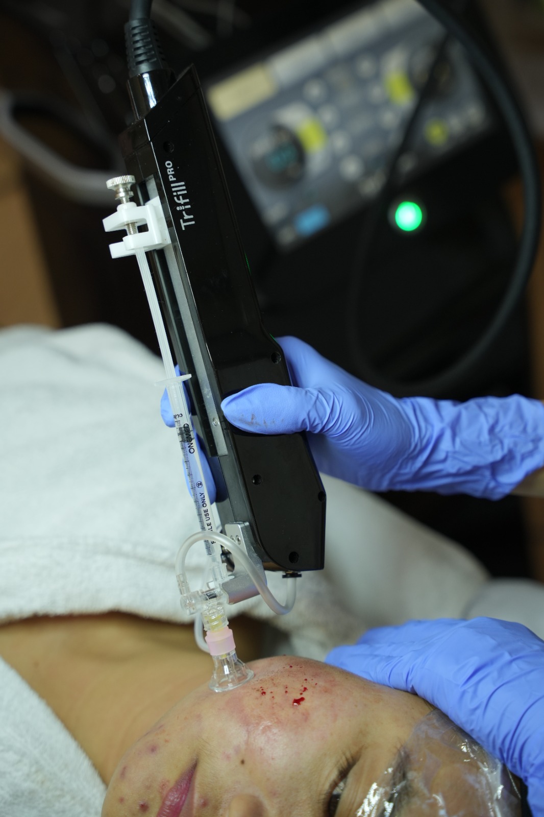 Trifill Scar Revival Treatment – CO₂ Subcision & Collagen Remodeling Treatment Trifill Scar Revival di Carla Skin Clinic menggunakan teknik CO₂ Subcision untuk membantu melepaskan jaringan fibrotik pada acne scar, dipadukan dengan pendekatan collagen remodeling untuk mendukung perbaikan tekstur kulit dan tampilan bopeng bekas jerawat.