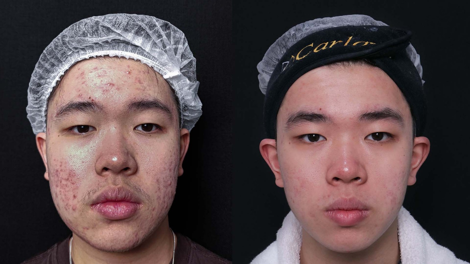 before after jerawat parah menjadi kulit lebih bersih setelah treatment acne di klinik estetika