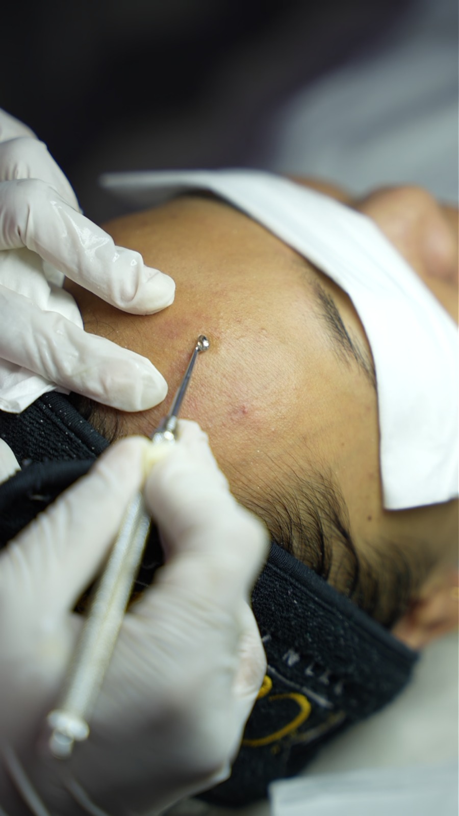 proses ekstraksi komedo oleh terapis profesional menggunakan alat steril pada kulit wajah berjerawat di klinik kecantikan