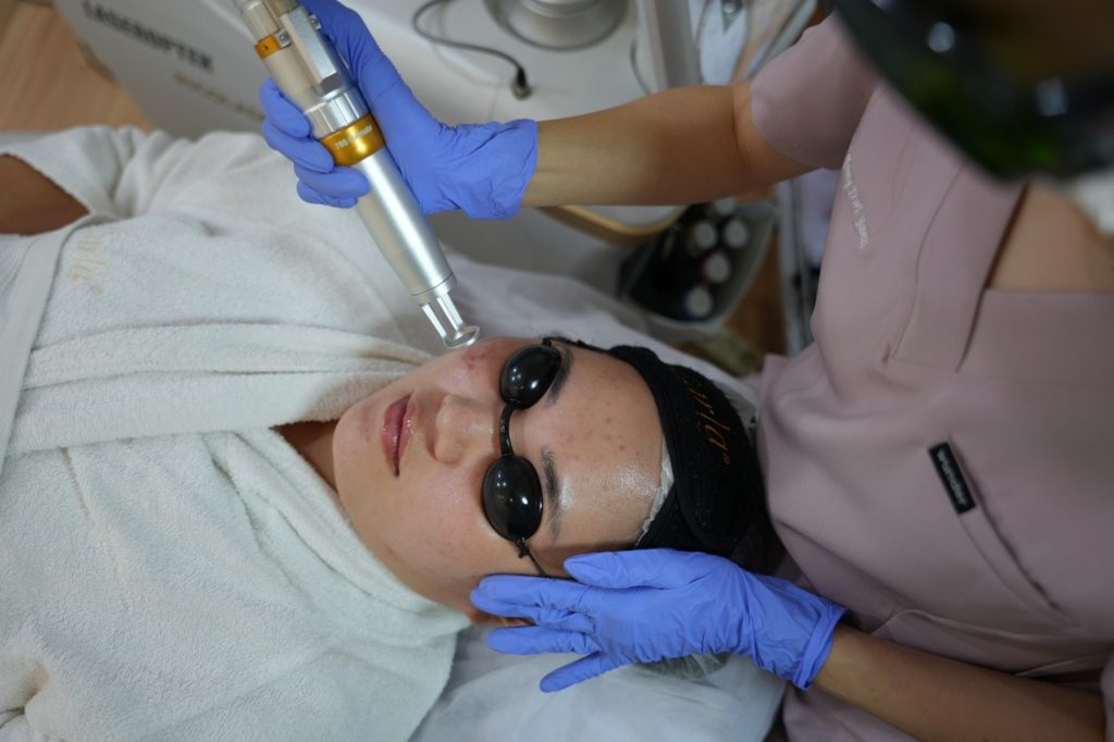 Pico Glass Laser untuk mengatasi melasma dan hiperpigmentasi pada wajah di Carla Skin Clinic dengan teknologi laser modern yang menargetkan melanin secara presisi