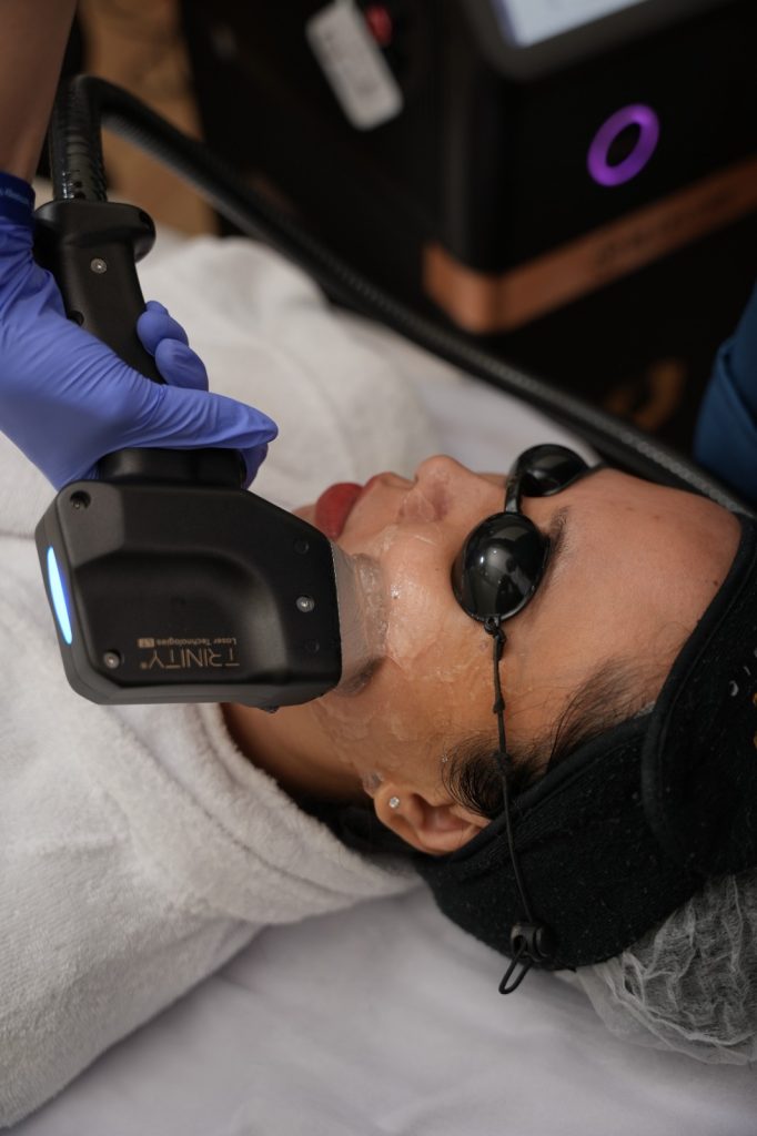 Solusi flek hitam Carla Skin Clinic dengan teknologi laser terbaru