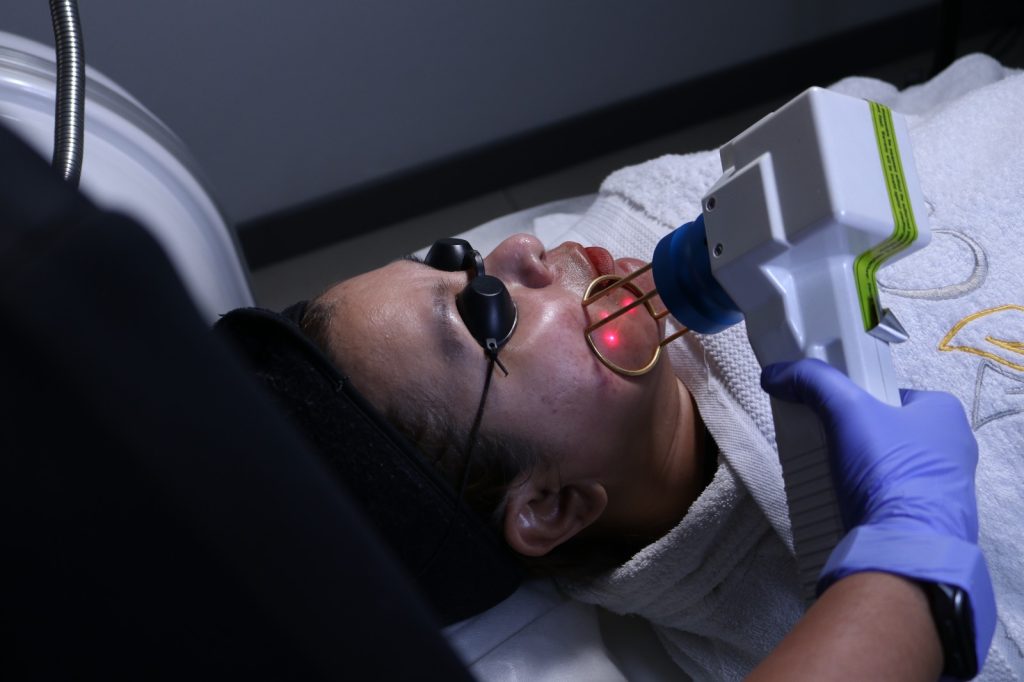 Prosedur C4 Rejuvenation dengan Laser Sellas untuk mengatasi jerawat dan bekasnya di klinik jerawat terbaik Jakarta.