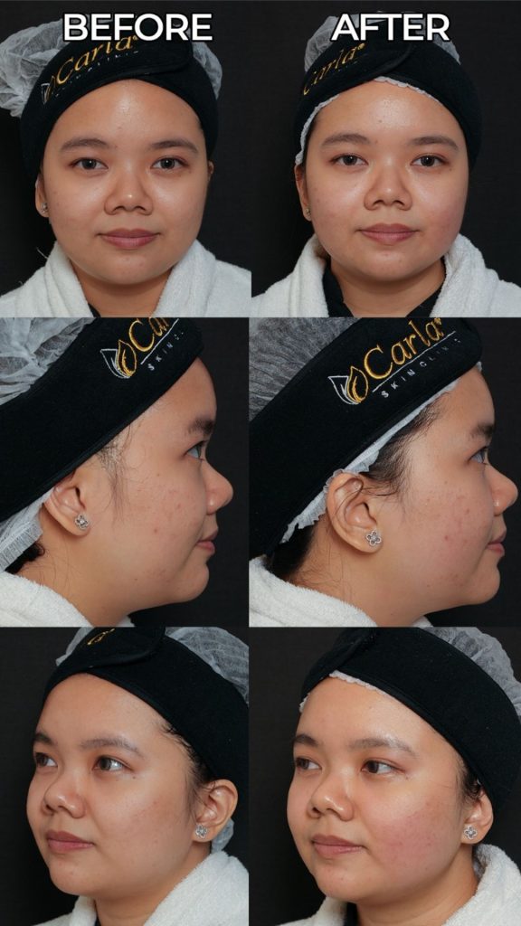 Perbandingan sebelum dan sesudah perawatan lifting wajah menggunakan teknologi New Doublo 2.0 di Carla Skin Clinic, menunjukkan rahang lebih kencang dan double chin berkurang.